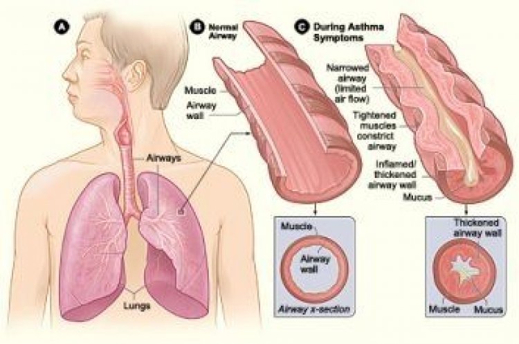 Τι είναι το άσθμα;