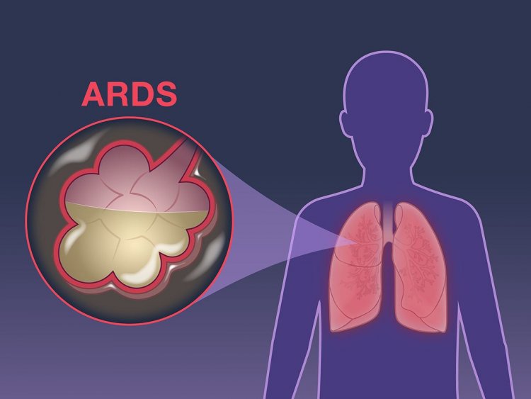 Coronavirus : Χαράλαμπος Μόσχος - Στις σοβαρότερες μορφές οι πνεύμονες αντί για αέρα γεμίζουν με «υγρό»