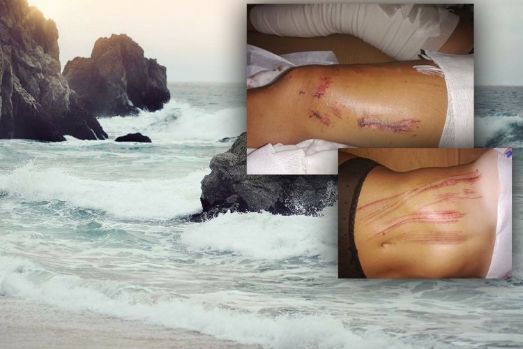 Mykonos: 40 ράμματα σε λουόμενη από τα απόνερα ταχύπλοου στην παραλία Κάπαρη