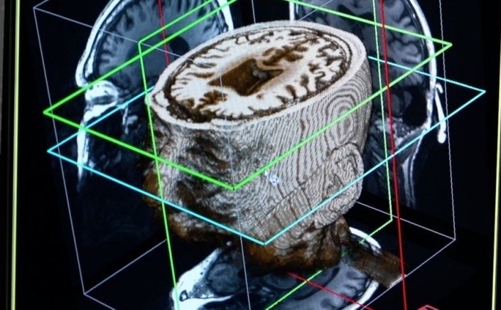 Artificial Intelligence: Η τεχνητή νοημοσύνη θα μπορούσε να χρησιμοποιηθεί για τη διάγνωση της άνοιας