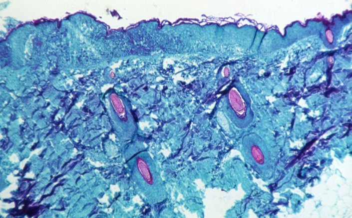 Monkeypox virus: Τι γνωρίζουμε έως τώρα για την ευλογιά των πιθήκων